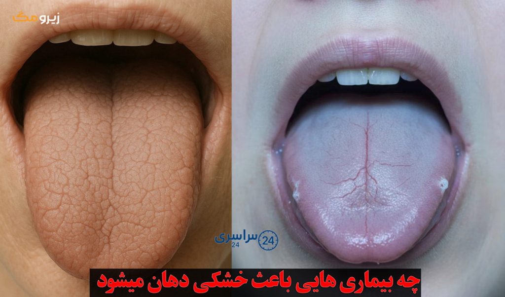 علت خشکی دهان در شب و خواب چیست؟ چه بیماری هایی باعث خشکی دهان میشود