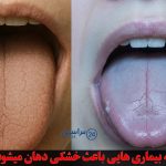 علت خشکی دهان در شب و خواب چیست؟ چه بیماری هایی باعث خشکی دهان میشود