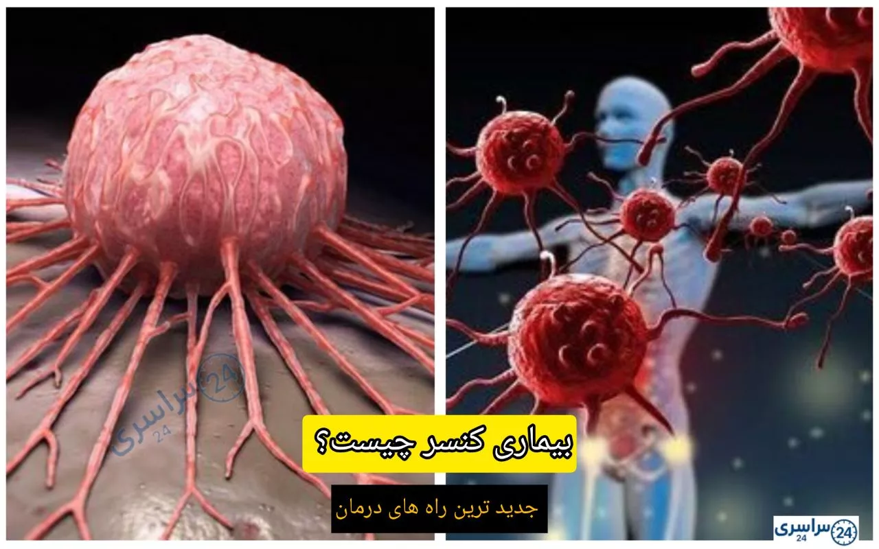 بیماری کنسر چیست؟ ؛ جدید ترین راه های درمان