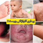 بیماری کاوازاکی چیست + راهنمای تشخیص و درمان سریع