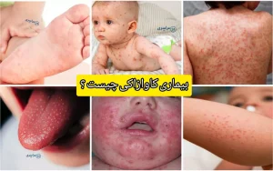 بیماری کاوازاکی چیست + راهنمای تشخیص و درمان سریع