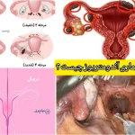 بیماری آندومتریوز چیست + بهترین روش‌های دارویی و جراحی تضمینی