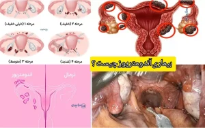 بیماری آندومتریوز چیست + بهترین روش‌های دارویی و جراحی تضمینی