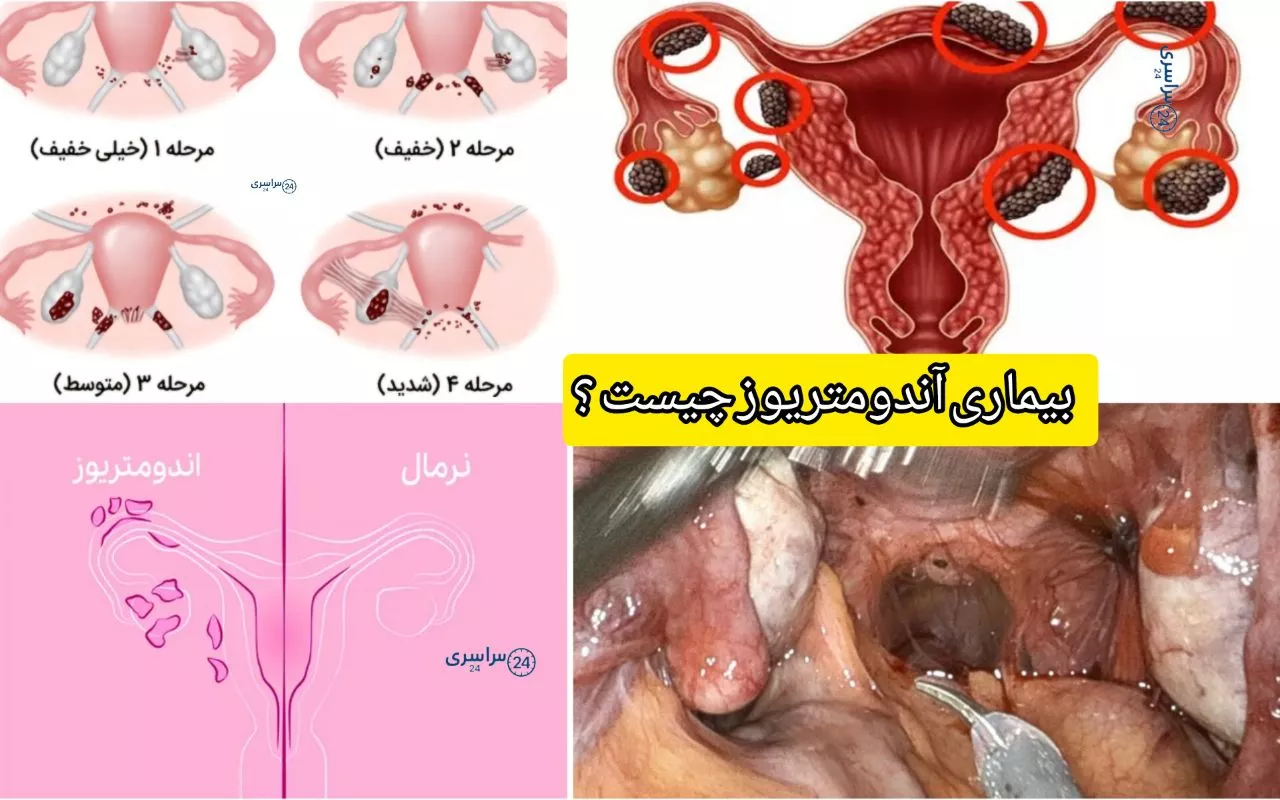 بیماری آندومتریوز چیست + بهترین روش‌های دارویی و جراحی تضمینی