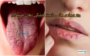 چه بیماری هایی باعث خشکی دهان میشود + زروستومیا و بهترین روش درمان