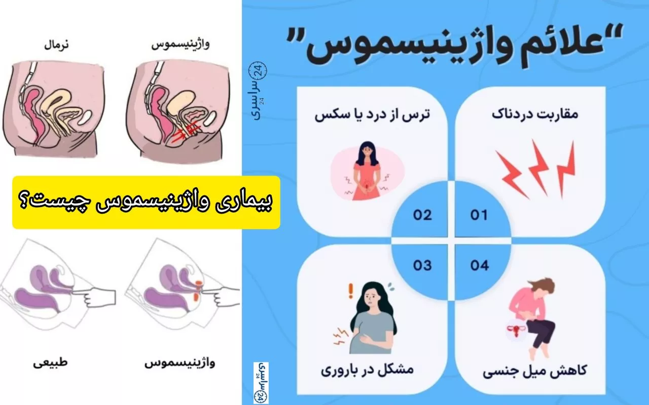 بیماری واژینیسموس چیست +علائم و بهترین روش درمان