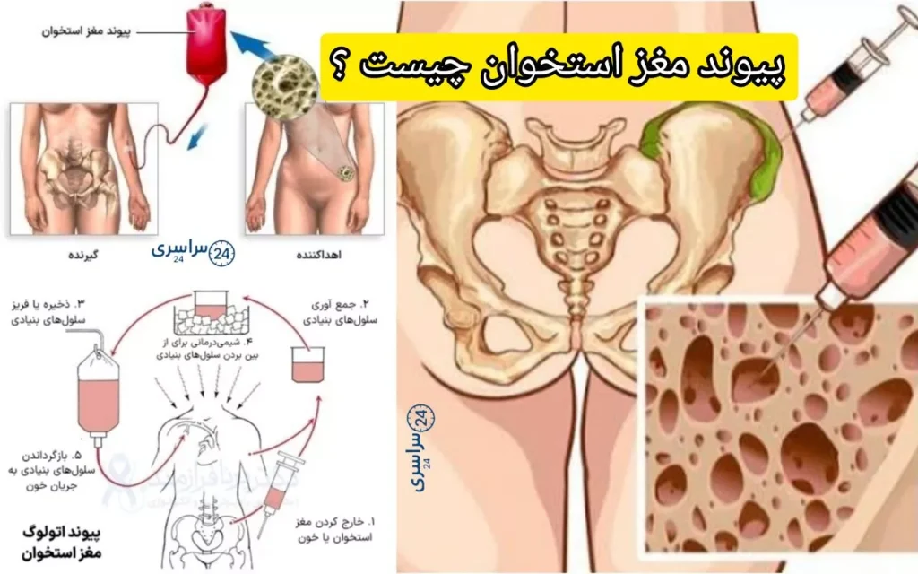 پیوند مغز استخوان چیست ؟ + تمامی مراحل درمان