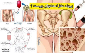 پیوند مغز استخوان چیست ؟ + تمامی مراحل درمان
