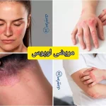 مریضی لوپوس + علائم و دلایل و روش های درمان