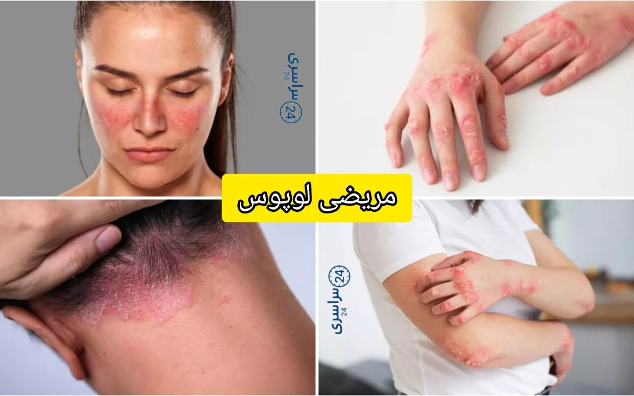 مریضی لوپوس + علائم و دلایل و روش های درمان