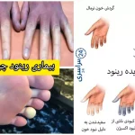 بیماری رینود چیست و چطور می‌شود کنترلش کرد؟