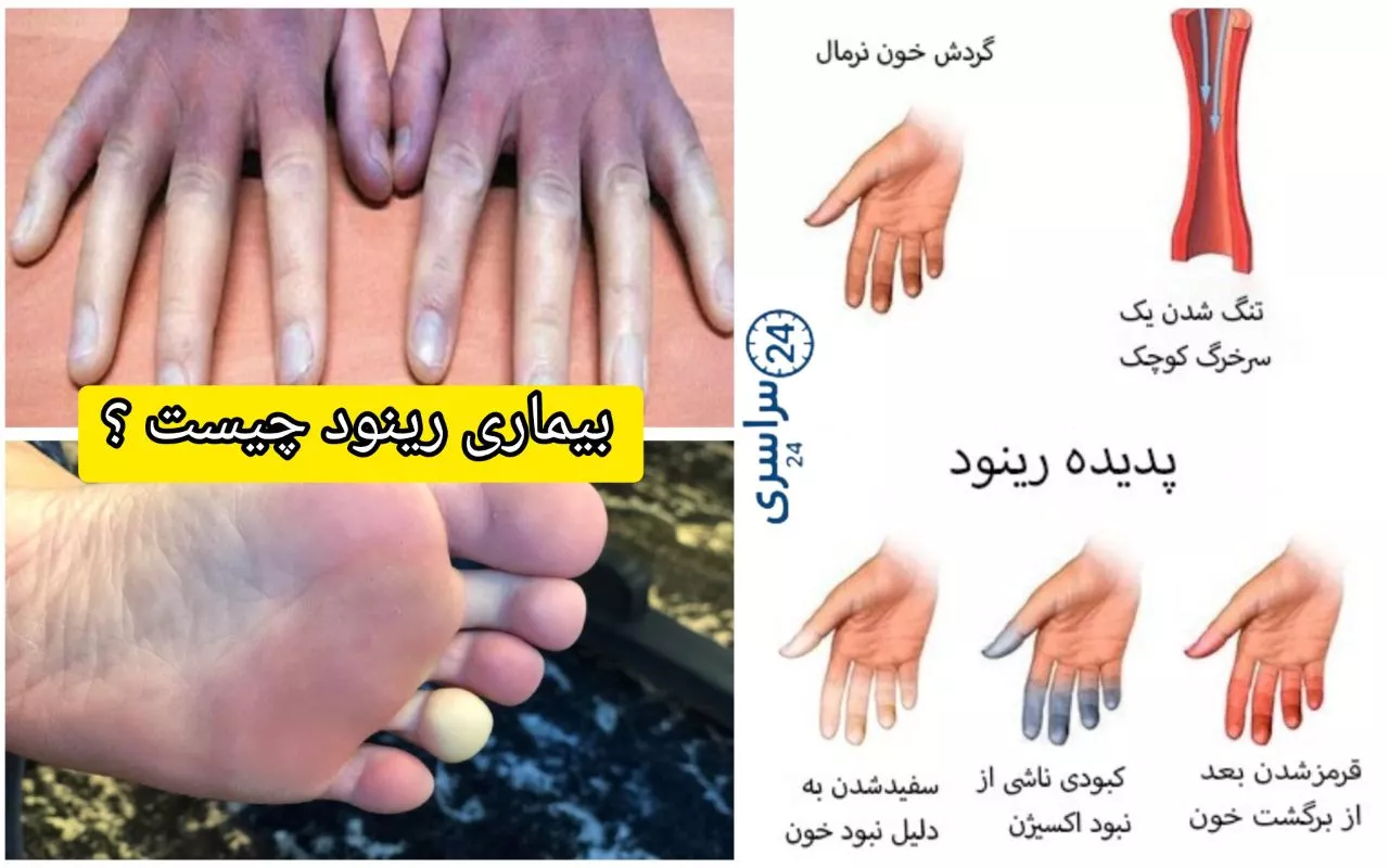 بیماری رینود چیست و چطور می‌شود کنترلش کرد؟