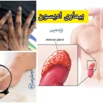 بیماری ادیسون + وقتی بدن در برابر استرس کم می‌آورد