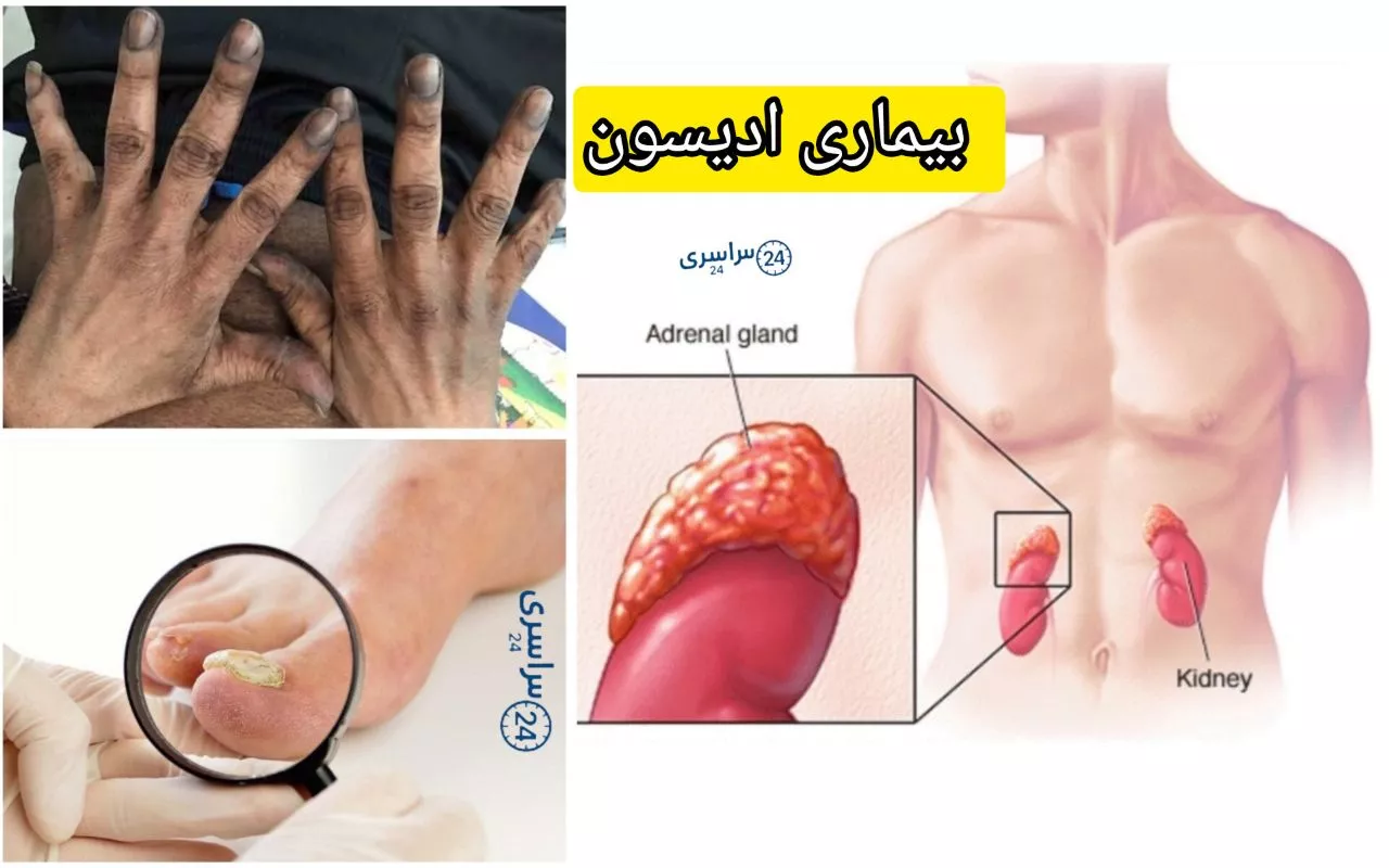 بیماری ادیسون + وقتی بدن در برابر استرس کم می‌آورد