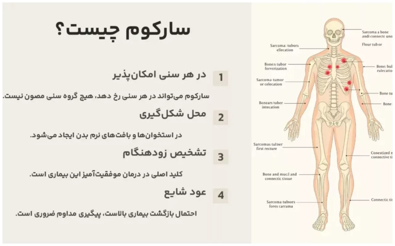 بیماری سارکوم سرطان نادر اما جدی + علائم، علت و درمان