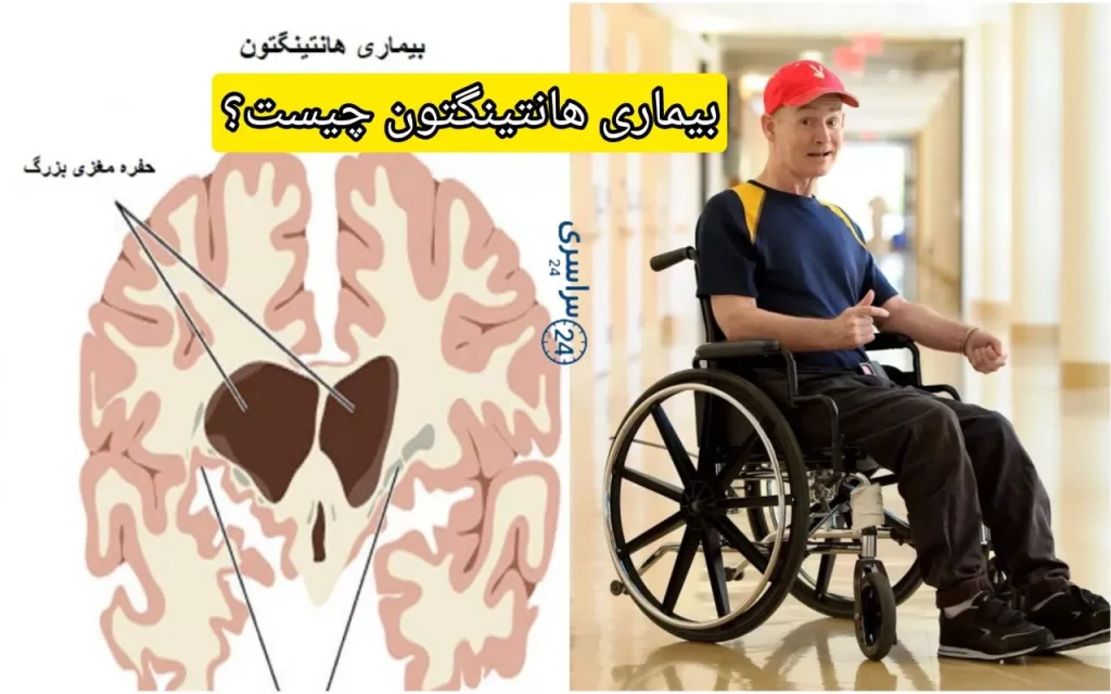 بیماری هانتینگتون چیست؟ + علائم، علت و درمان