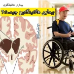 بیماری هانتینگتون چیست؟ + علائم، علت و درمان