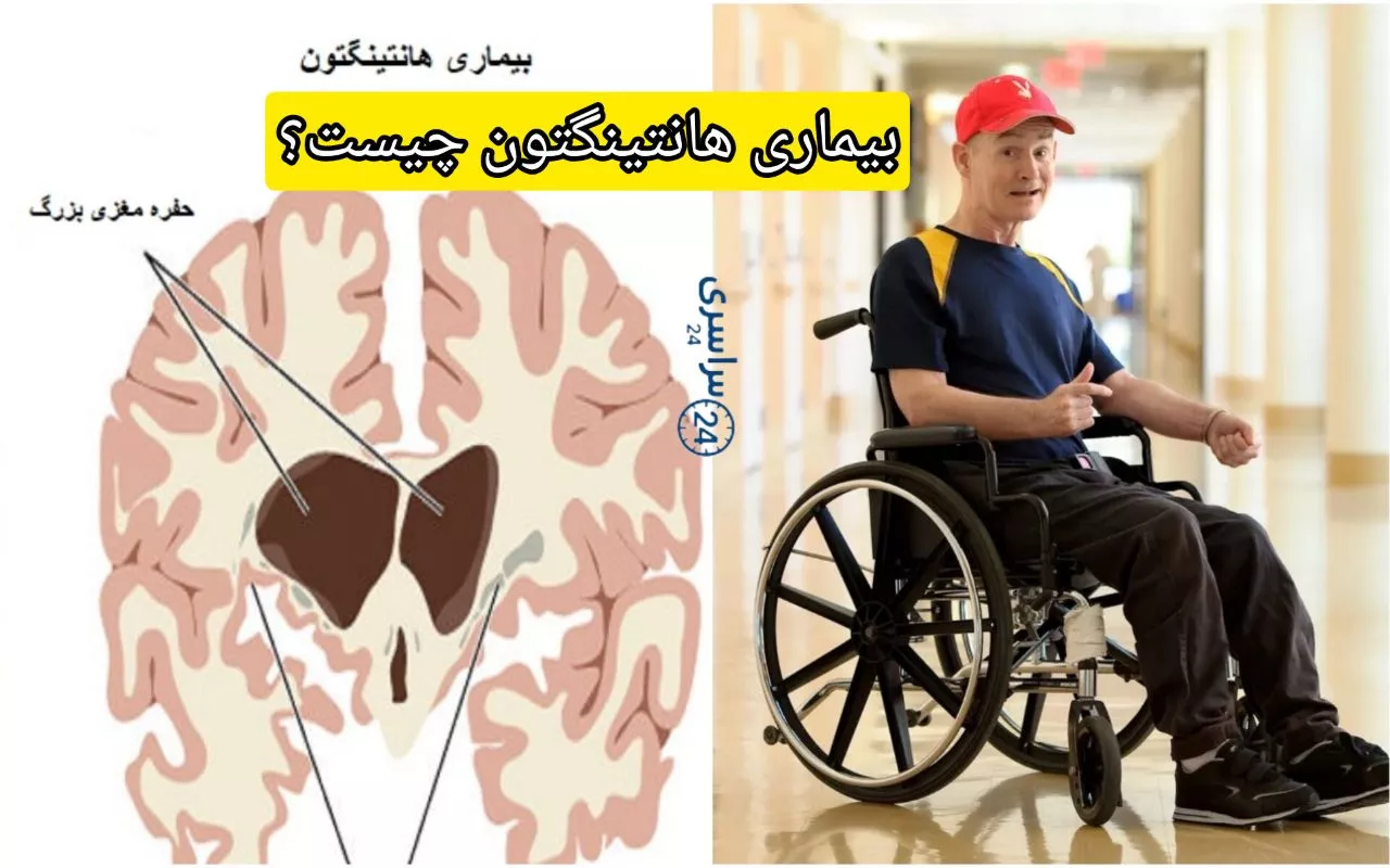بیماری هانتینگتون چیست؟ + علائم، علت و درمان
