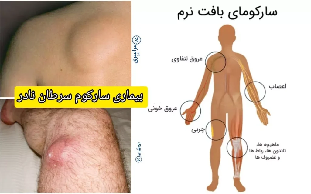 بیماری سارکوم سرطان نادر اما جدی + علائم، علت و درمان