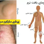 بیماری سارکوم سرطان نادر اما جدی + علائم، علت و درمان