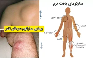 بیماری سارکوم سرطان نادر اما جدی  + علائم، علت و درمان
