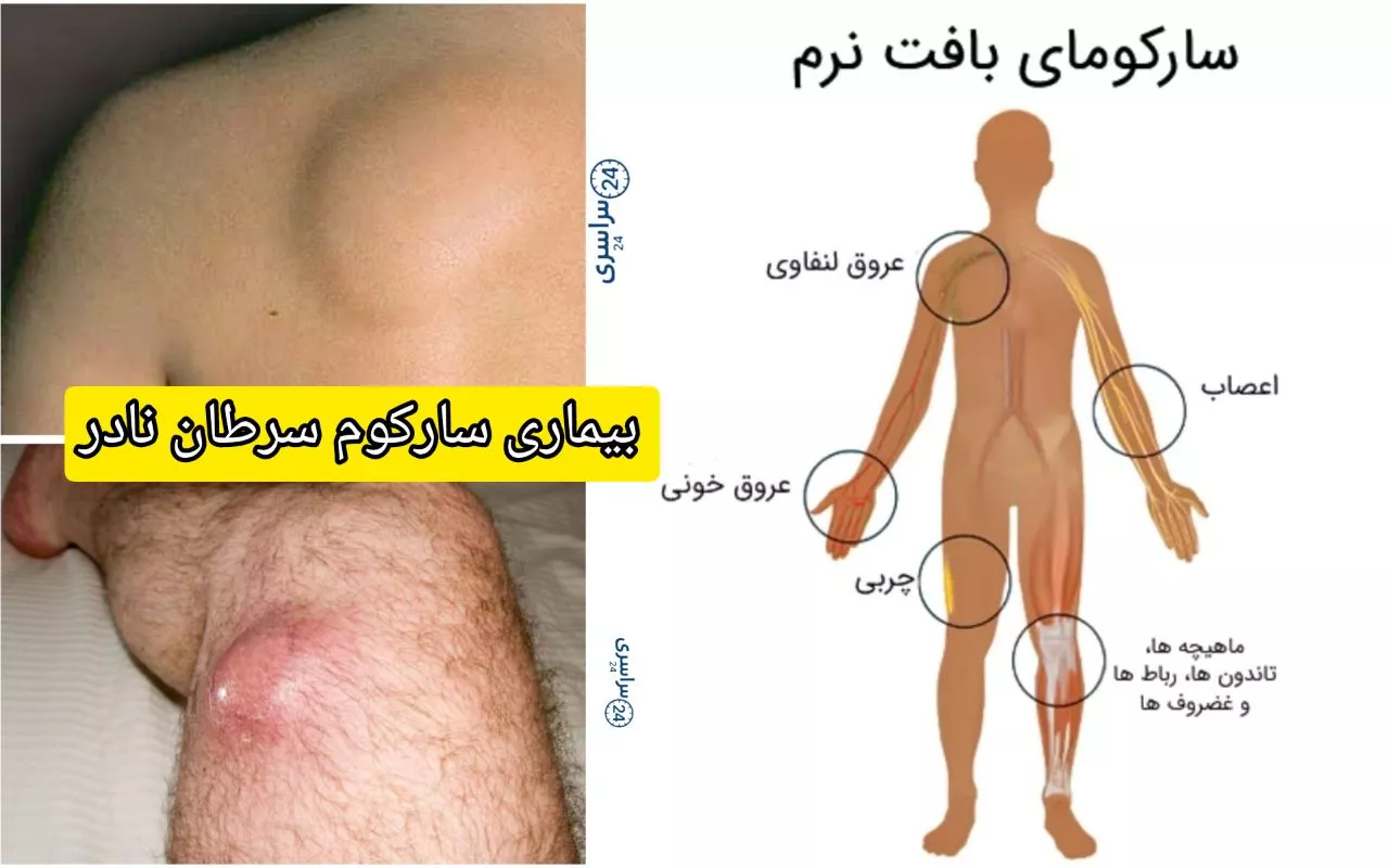 بیماری سارکوم سرطان نادر اما جدی + علائم، علت و درمان