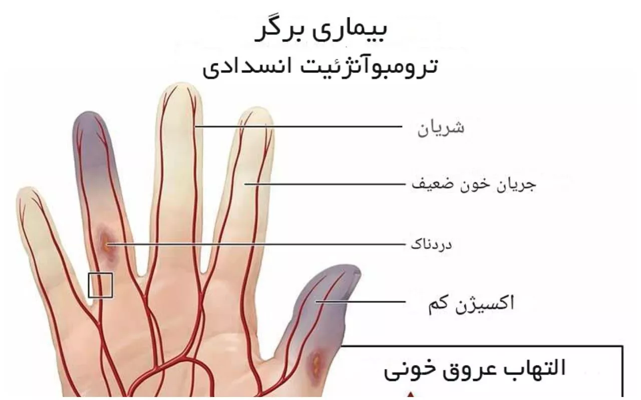 بیماری برگر چیست؟ وقتی سیگار مستقیماً به رگها حمله میکند
