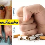 بیماری برگر چیست؟ وقتی سیگار مستقیماً به رگ‌ها حمله می‌کند