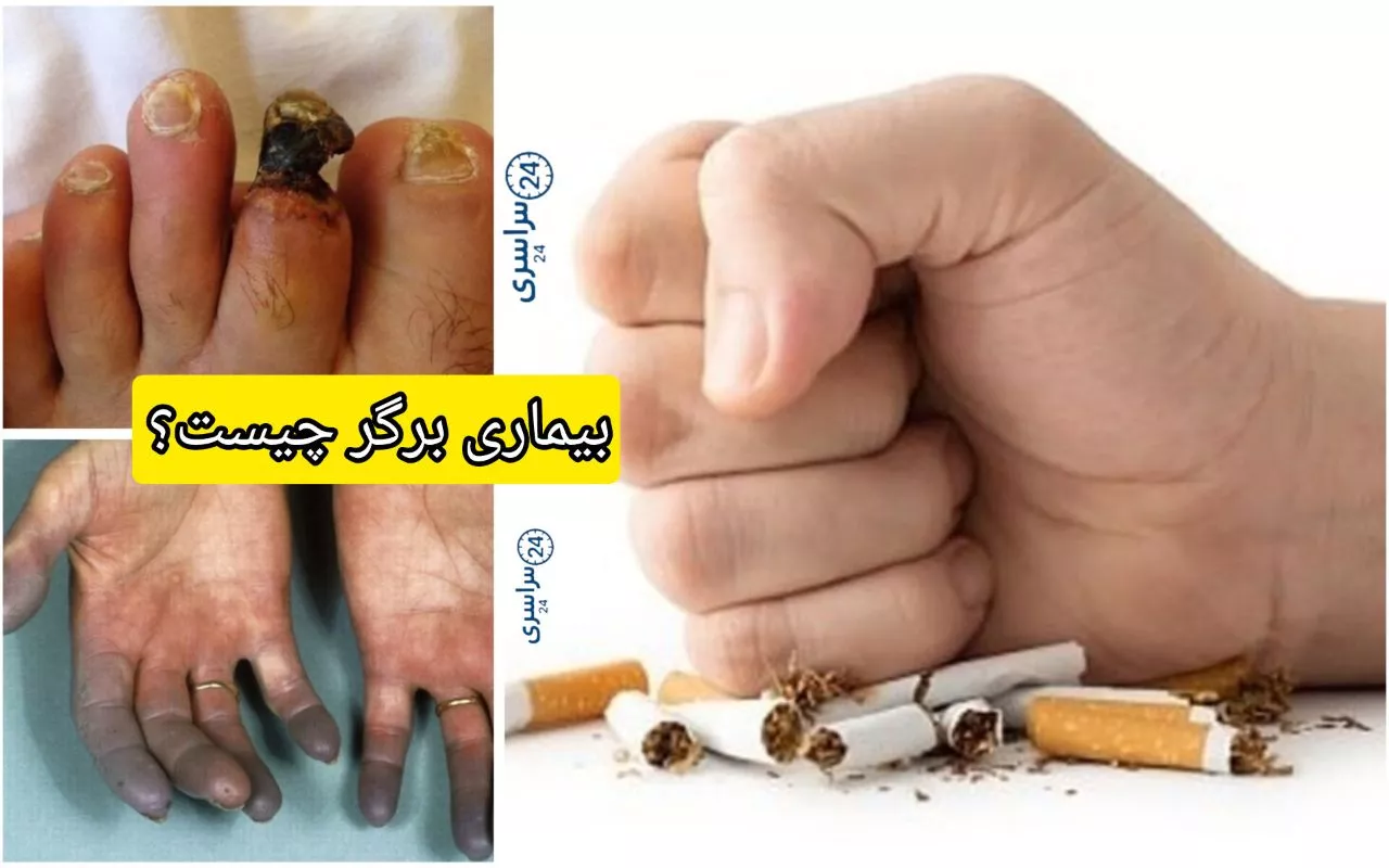 بیماری برگر چیست؟ وقتی سیگار مستقیماً به رگ‌ها حمله می‌کند