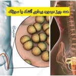 بیماری آتشک در انسان + سوزاک و علائم پنهان و راه درمان