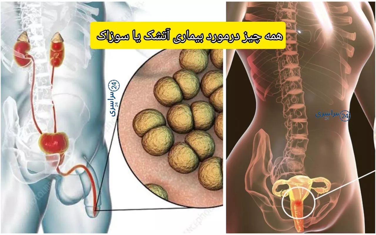 بیماری آتشک در انسان + سوزاک و علائم پنهان و راه درمان