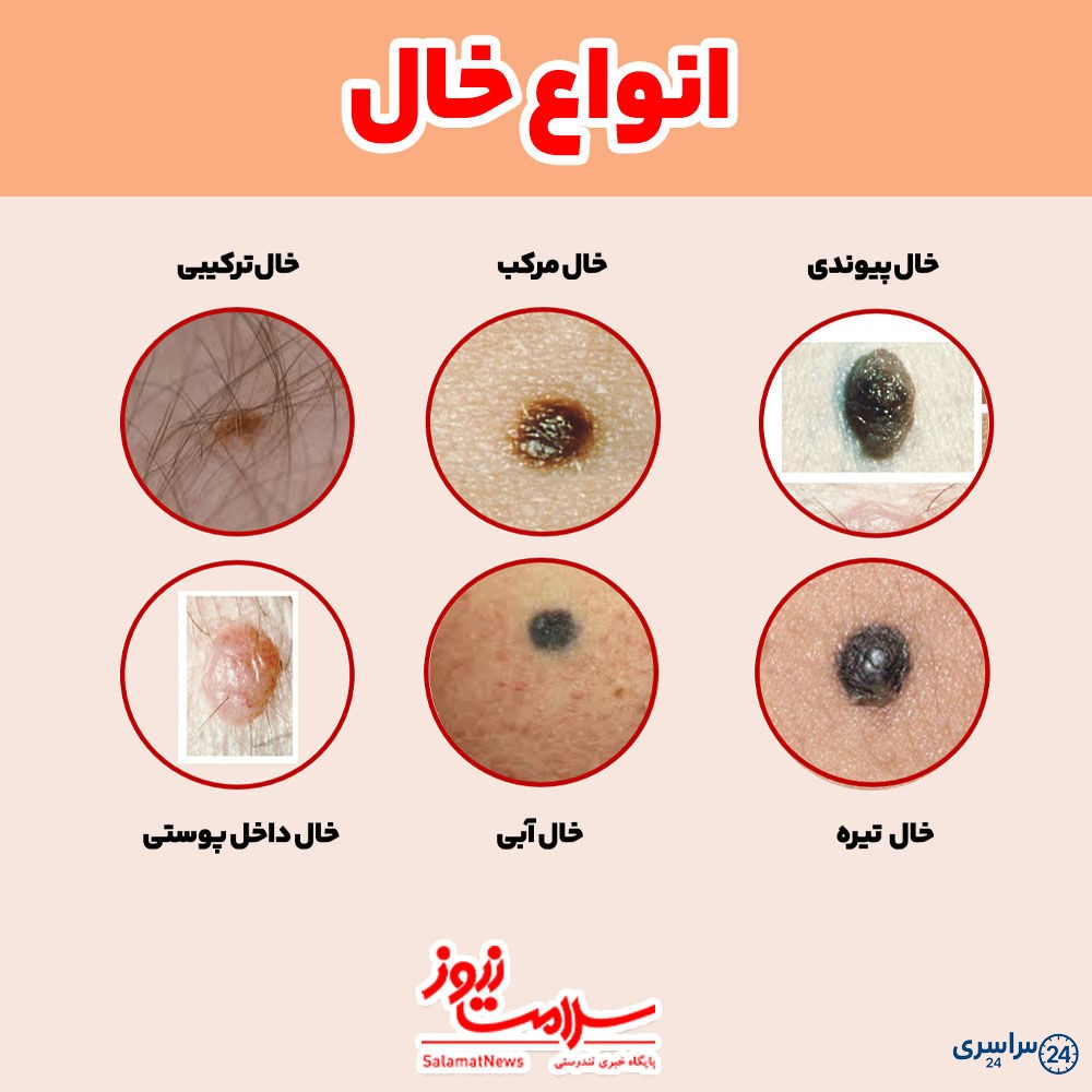 عکس خال های سرطانی