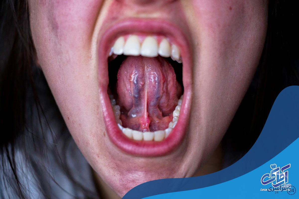 عکس ضایعات زیر زبان
