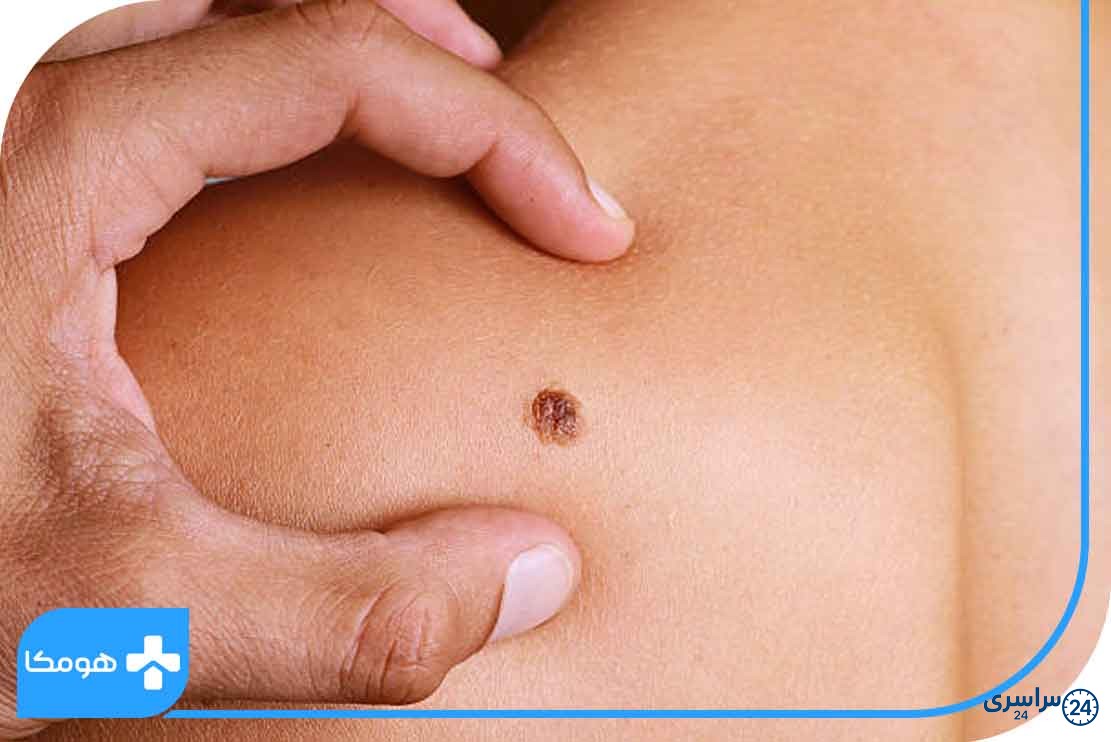عکس خال های سرطانی