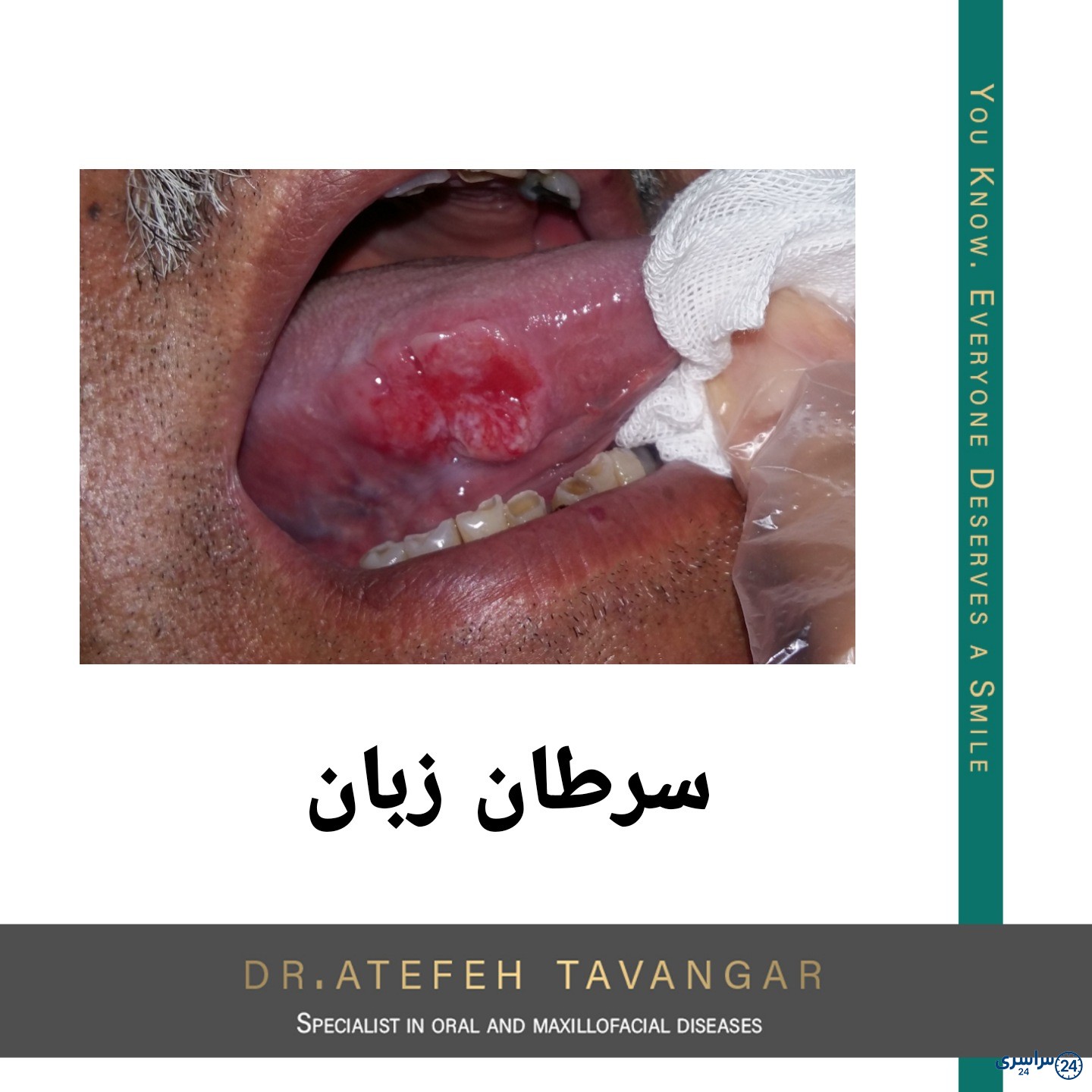 عکس ضایعات زیر زبان