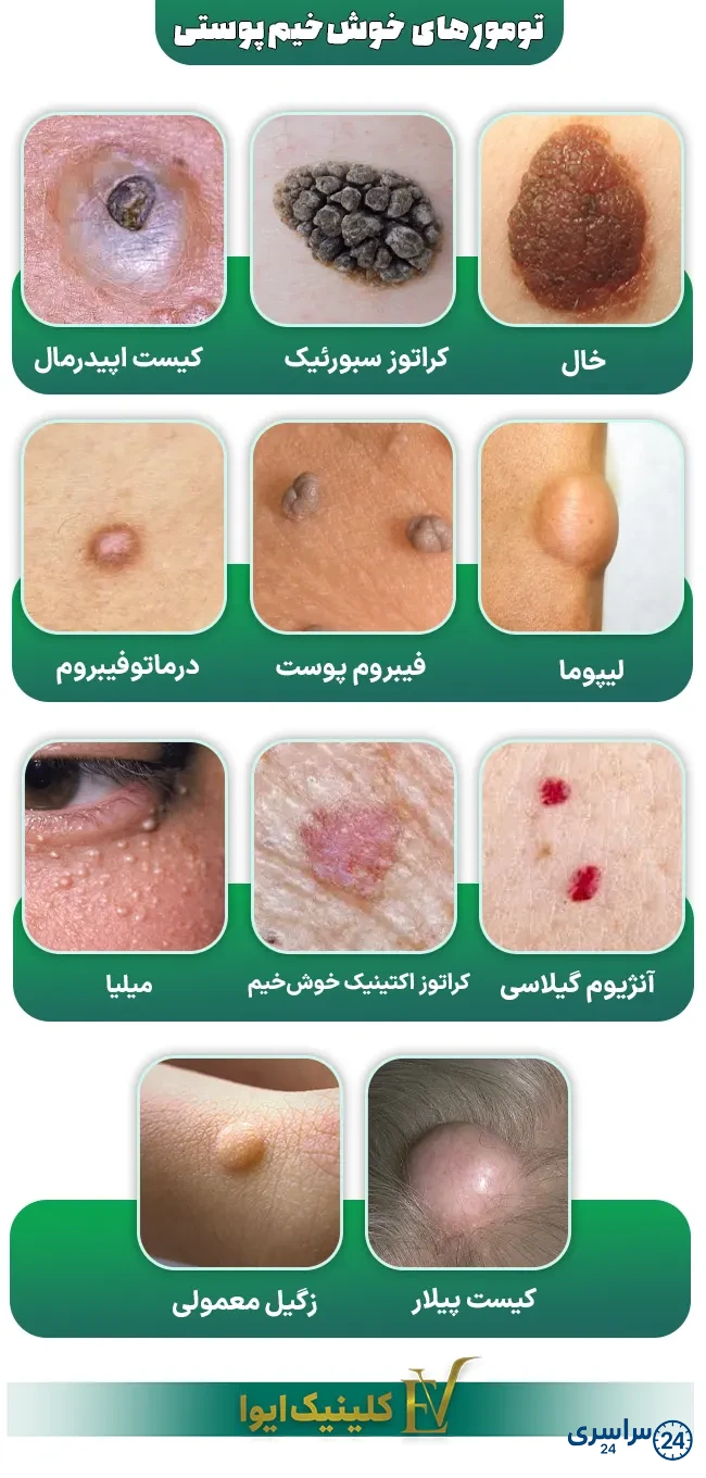 عکس خال های سرطانی