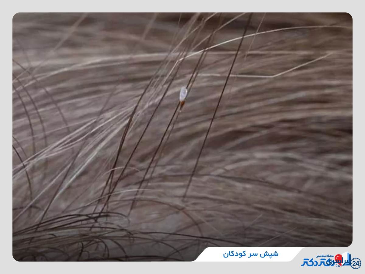 عکس شپش سر